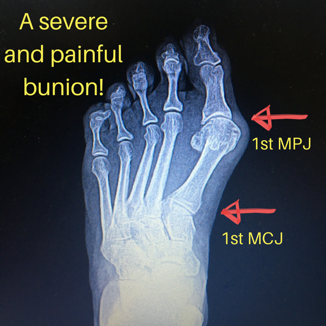 bunionectomy x ray