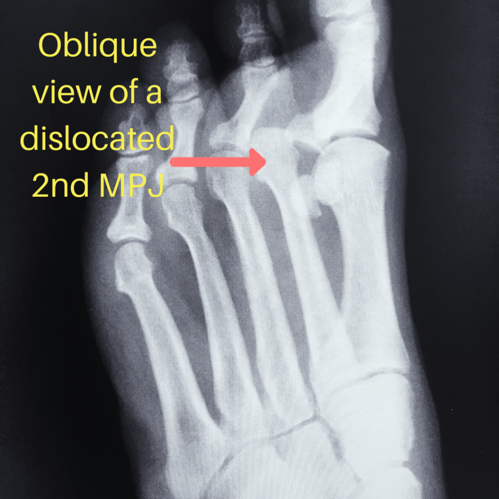 Plantar Plate Injury Final Kick Ankle and Foot Clinic Ankle and Foot