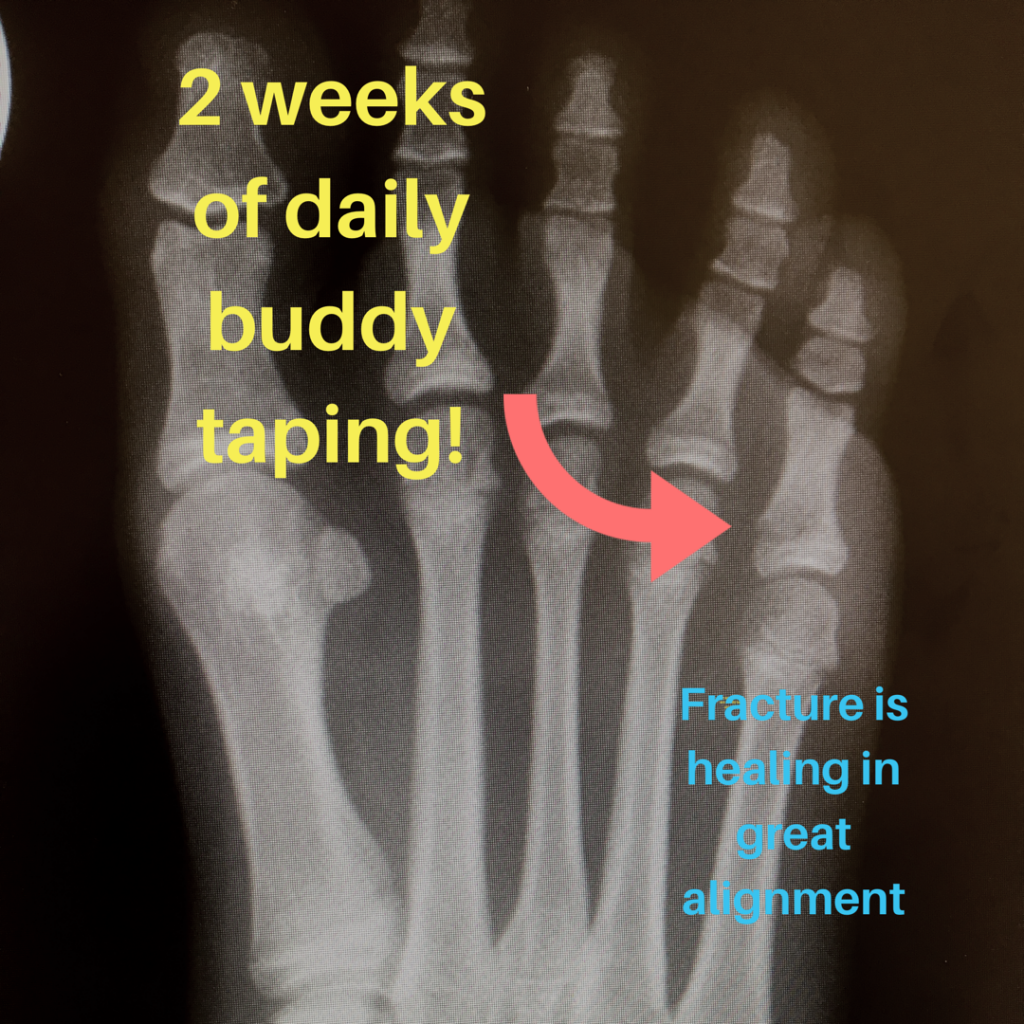 Buddy Tape Your Toe Fracture Final Kick Ankle and Foot Clinic Ankle and Foot Clinic